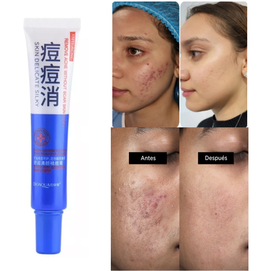 Crema Anti Acné Poros Cicatrices Piel Grasa