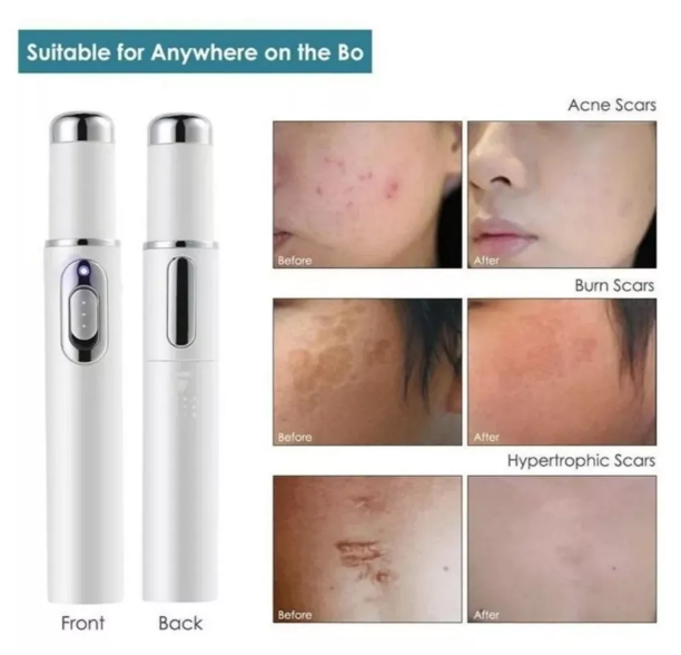 Lápiz Láser Masaje Luz Azul