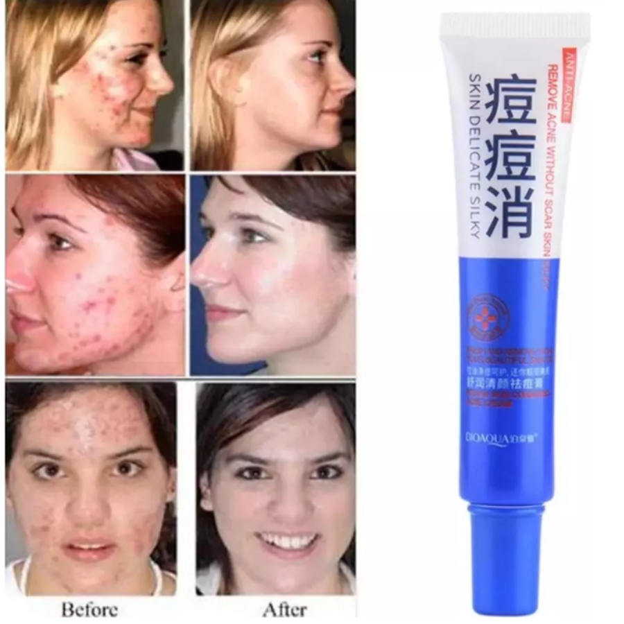 Crema Anti Acné Poros Cicatrices Piel Grasa