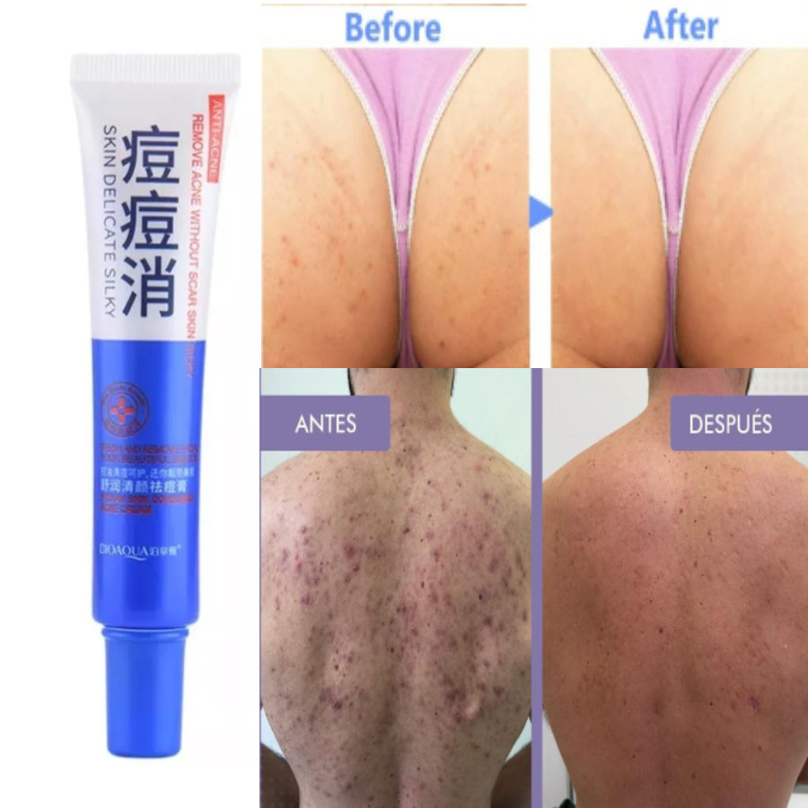 Crema Anti Acné Poros Cicatrices Piel Grasa